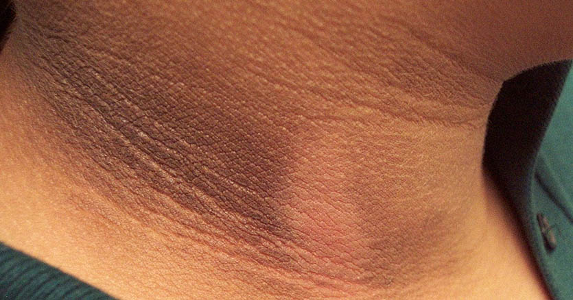 ធុញថប់នឹងស្បែកជាំខ្មៅក្នុងពេលមានផ្ទៃពោះ ម៉ាក់ៗកុំភ្លេចសាកល្បងវិធីសាស្រ្តទាំងនេះ!